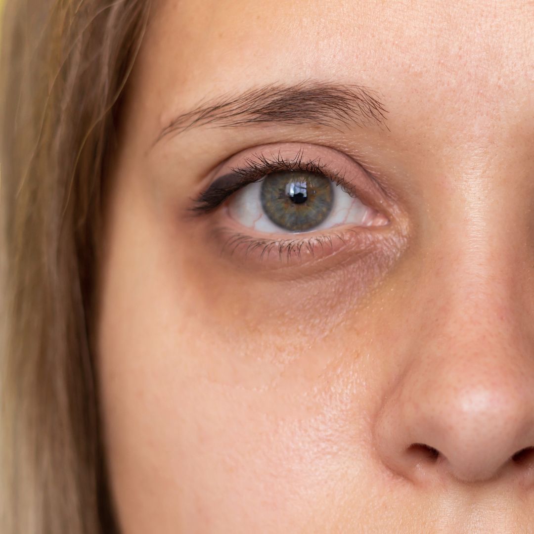 Cum să scapi de cearcane în mod eficient cu crema Anticearcăn Lumière